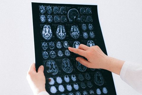 Miniature de Alzheimer : une découverte donne espoir pour de futurs traitements